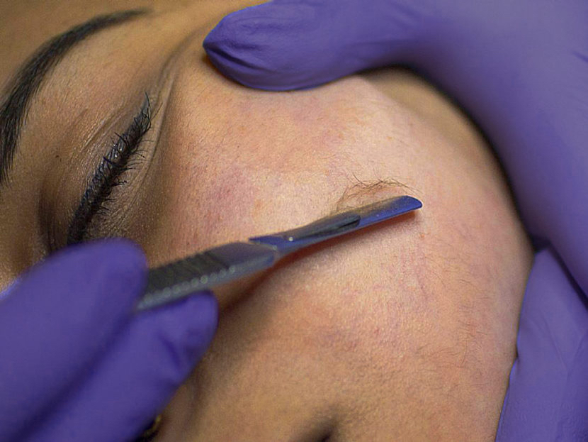 Dermaplane Add On
