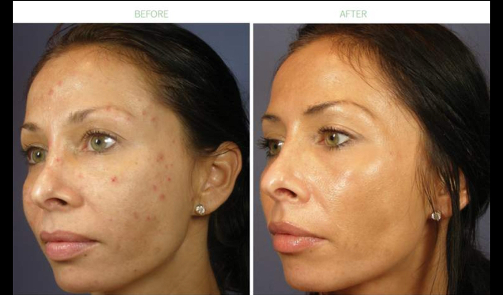 Enzyme  Peel Facial at MylaSkinCare in Los Angeles, CA