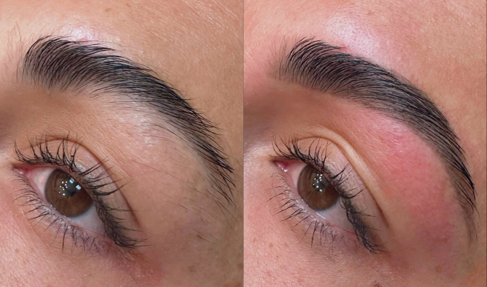 Brow Recovery