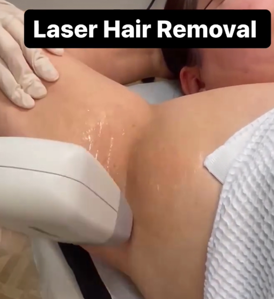 Laser Hair Removal