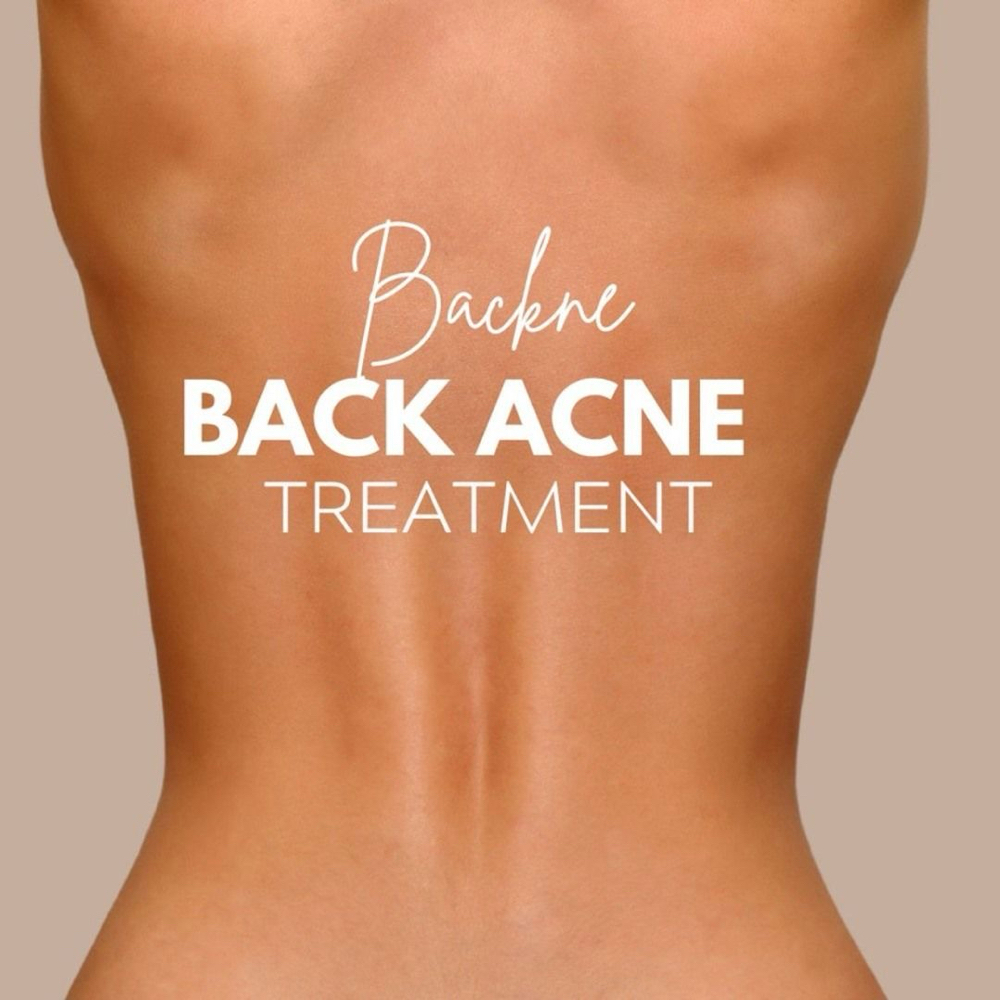 Back Acne Clearing Treatment at Skin Deep Beauty Spa in Sulphur, LA