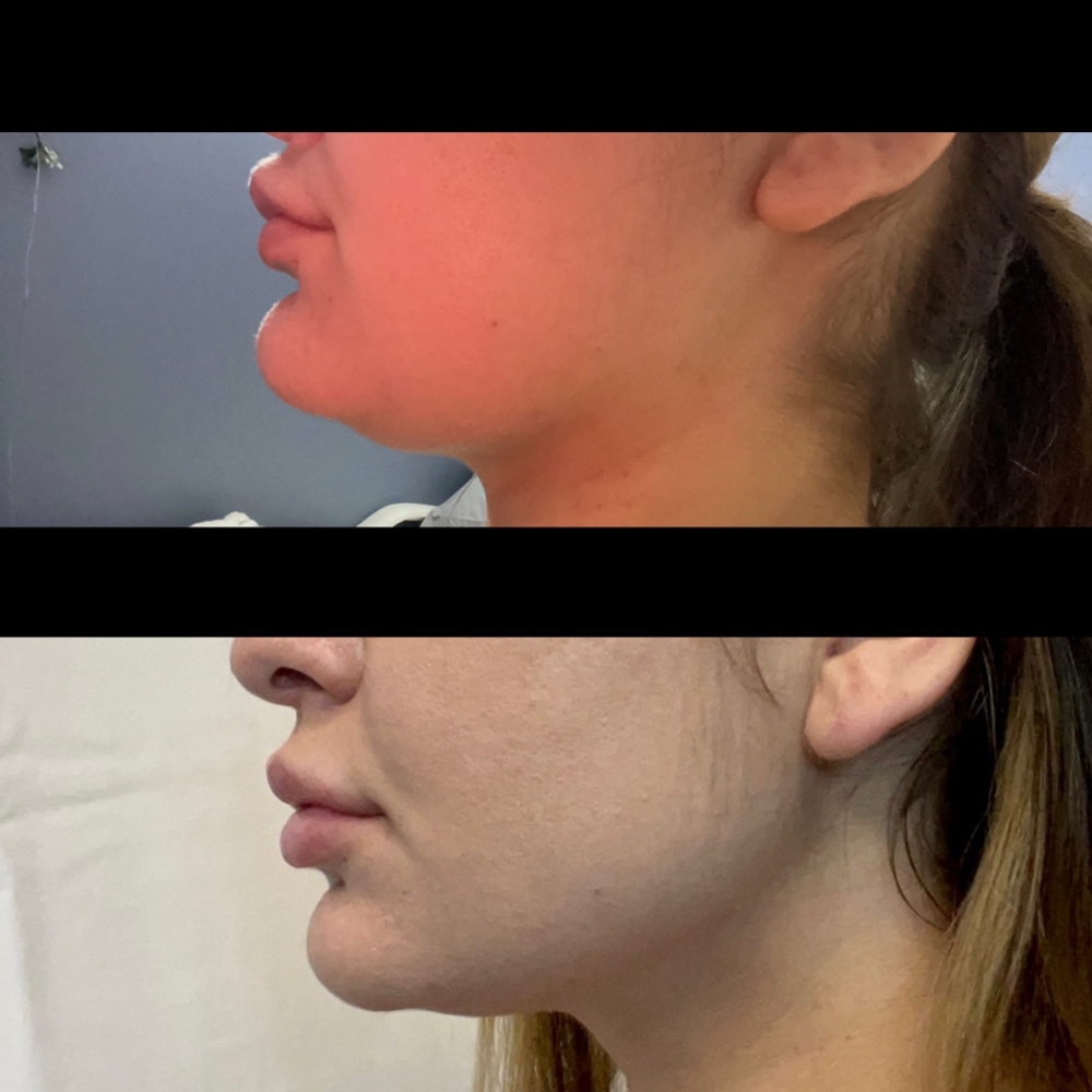 Laser Lipo Under Chin (4 Sessions)