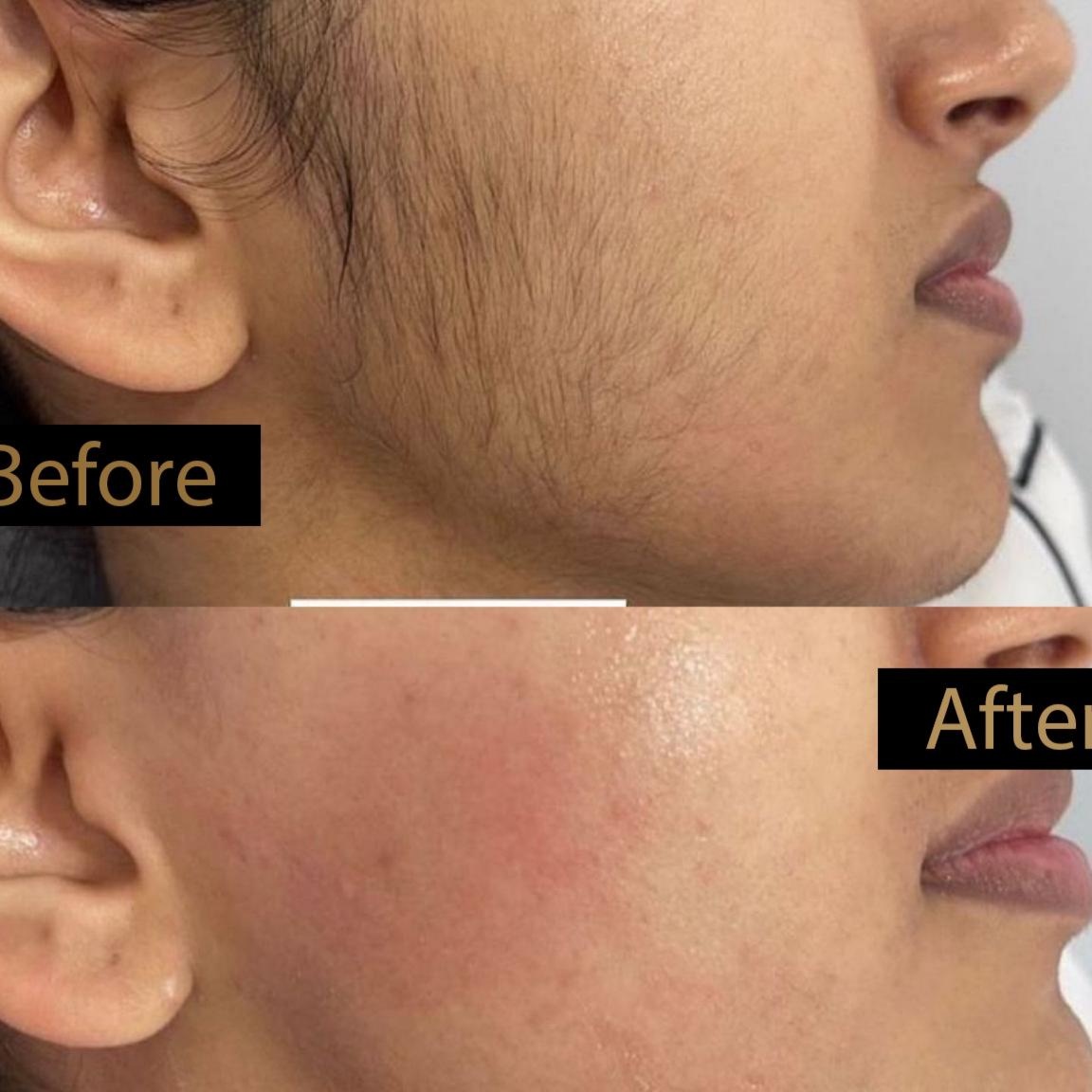 Full Face Laser Hair Removal at The Beautee Spot in Phoenix, AZ