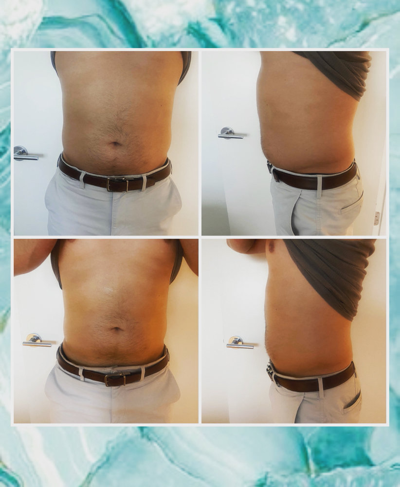 3 Sessions Hya Pen fat Dissolve