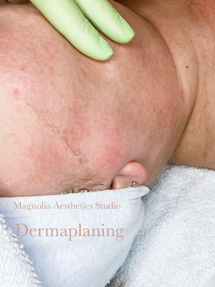 Dermaplaning