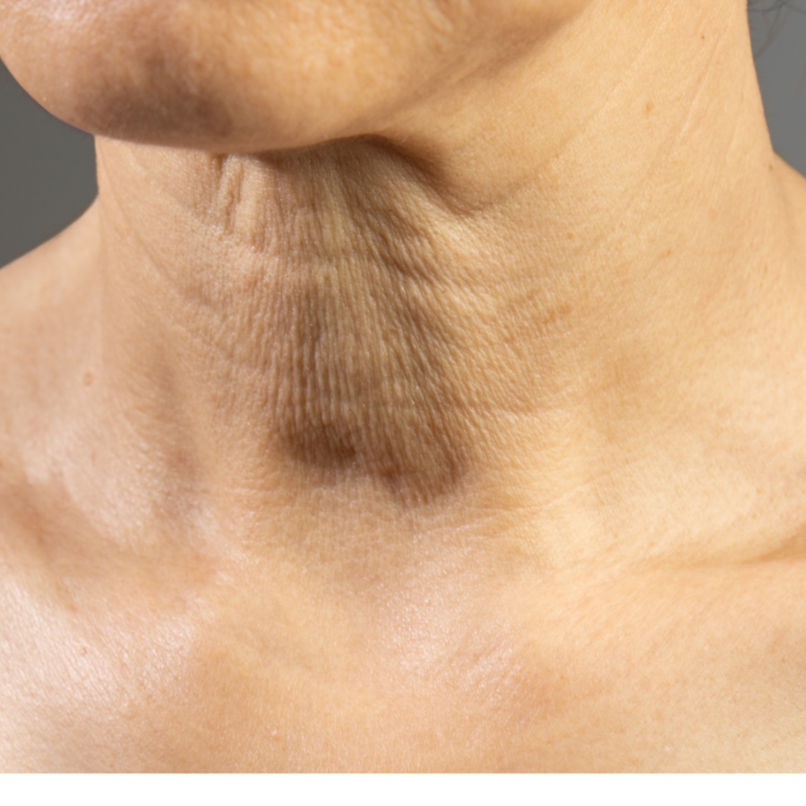 Moderate to Severe Neck Renewal at Empower Aesthetics in Canyon Lake, TX