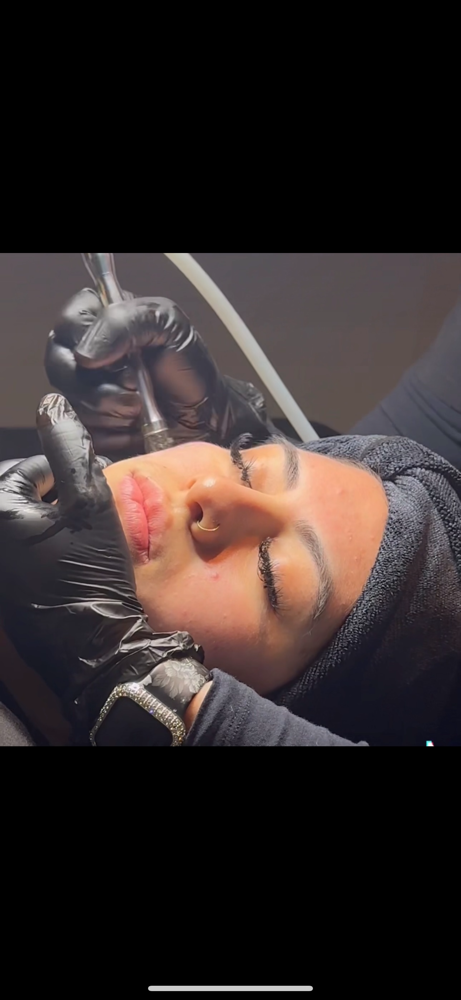 Microdermabrasion