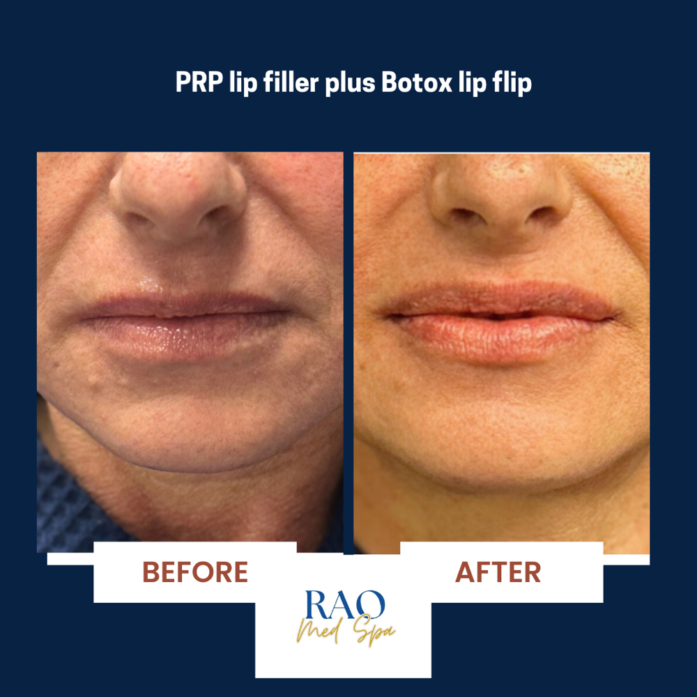 PRP Lip Injections