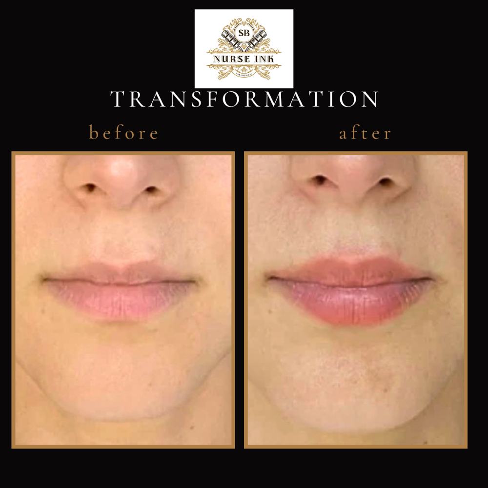 PRF Lip Injections at Nurse Ink/Rao Med Spa in Covington, LA