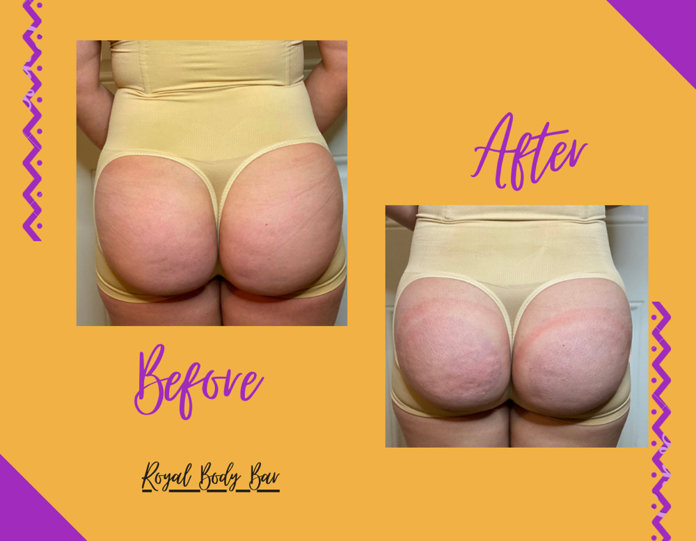 Buttocks and brest enhancement