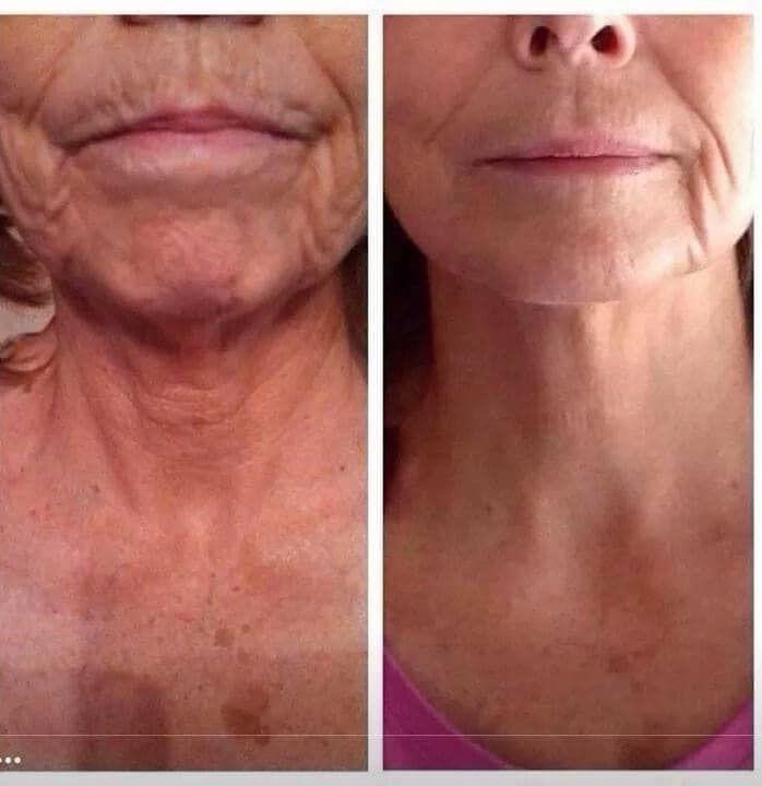 Face AND Neck COMBO ~ Procell Micro-Channeling