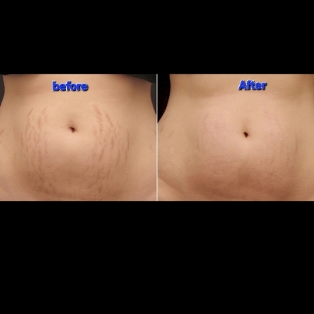 Streachmark Breakdown With Procell