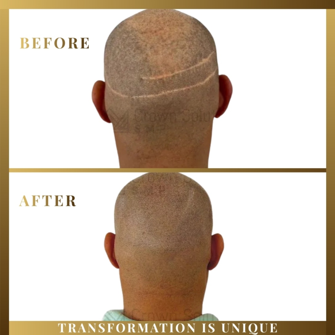 SMP Rebuild (Top + Crown)