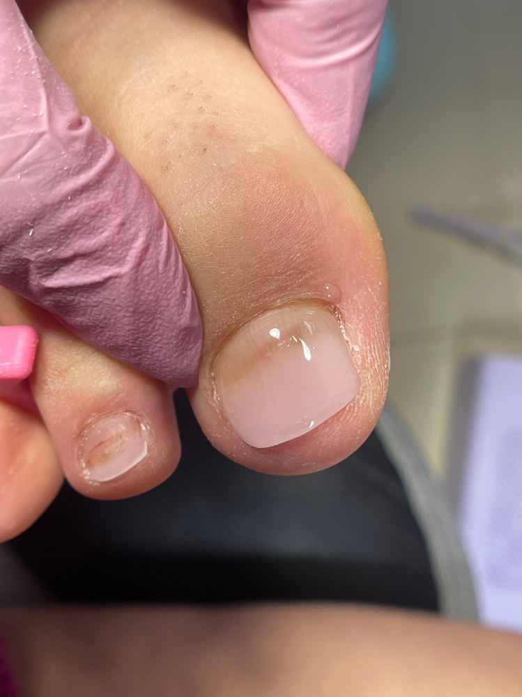 Cita Inicial Protesis Con Ibx 2uñas