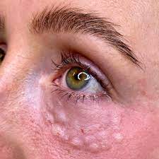 PDRN Undereye Mesotherapy