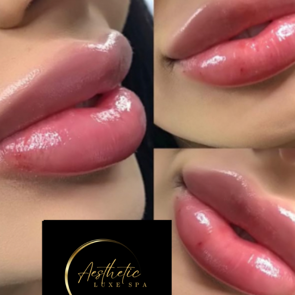 (.5 ML) Lip Filler at AESTHETIC LUXE SPA (Lees Summit) in Lees Summit, MO