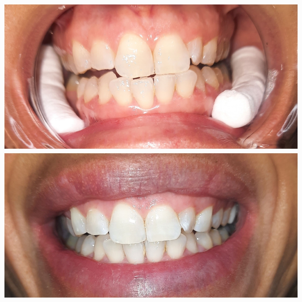 Teeth Whitening 1 Hour