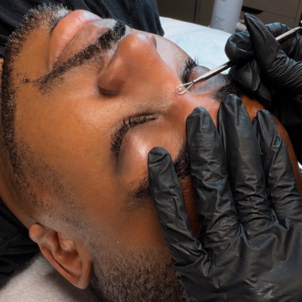Advanced Extractions at Meticulous Spa and Beauty in New Haven, CT