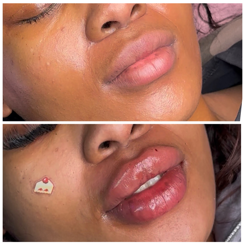 2mL (Restylane Kiss) at Pretty By Princess in Philadelphia, PA