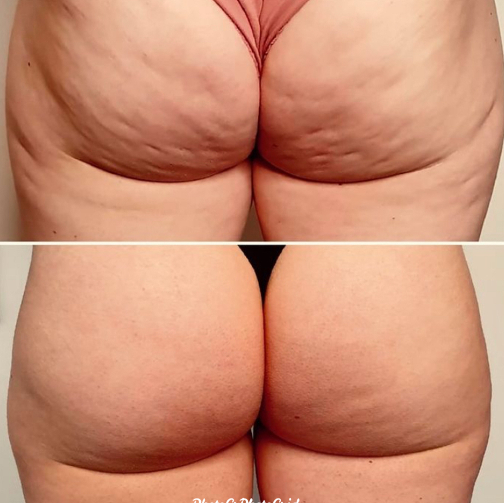 ENDERMOLOGIE at Anastasia’s Crown in Pittsburgh (Shadyside Area), PA