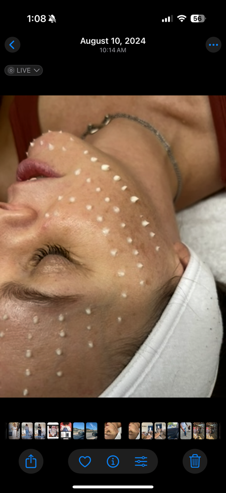 Liquid Microneedling Spa Facial