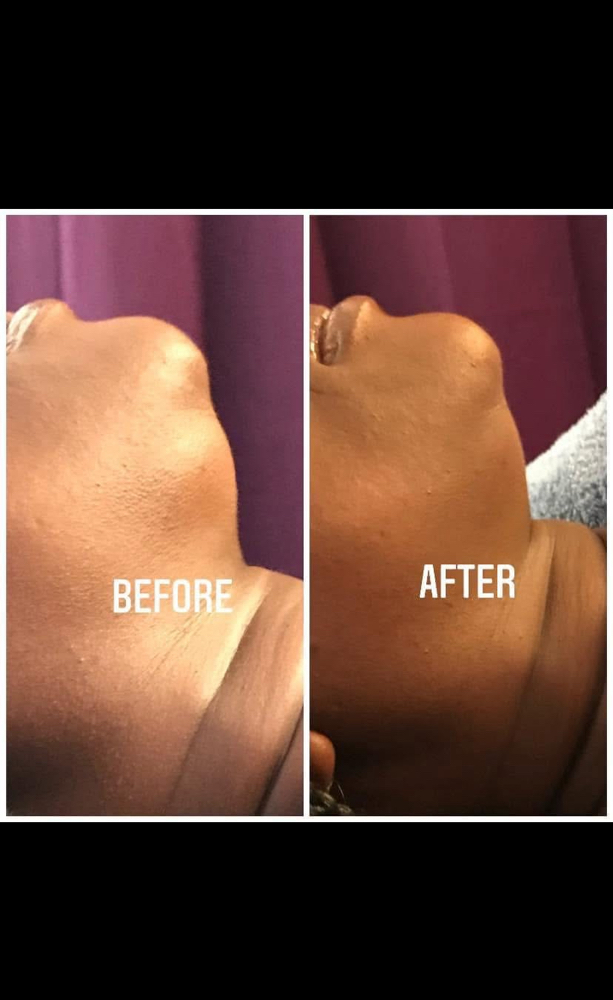 Chin/Neck Cavitation