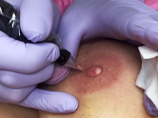 Areola / Nipple Tattooing Procedure
