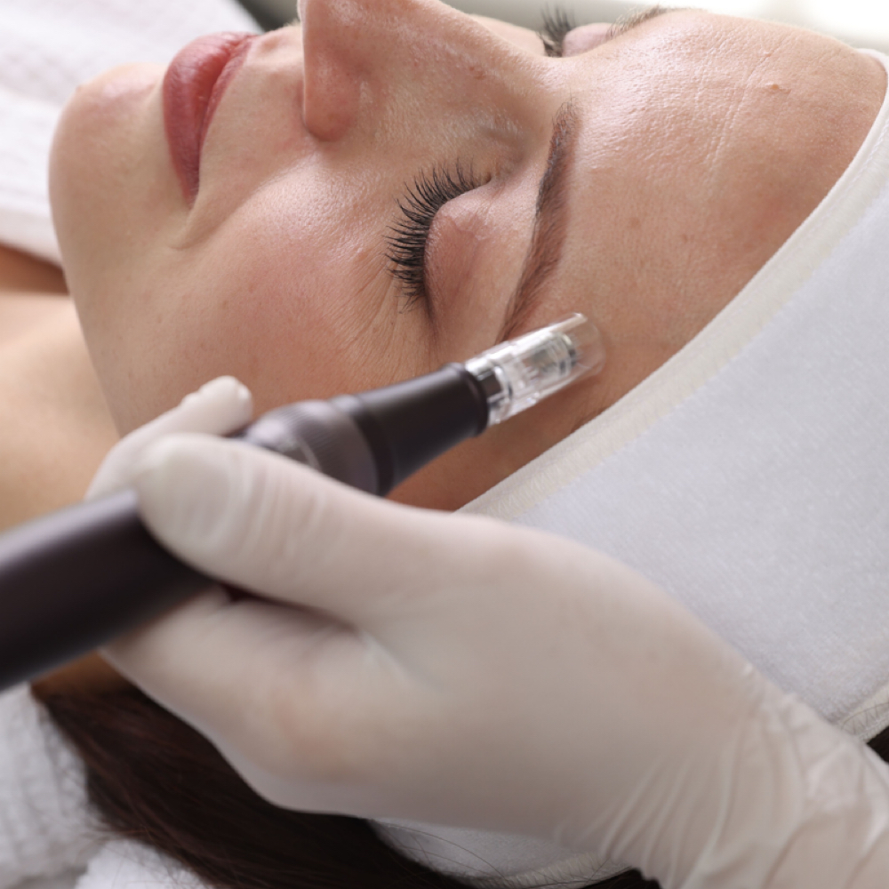 Microneedling at AZ Brows & Skin in Scottsdale, AZ