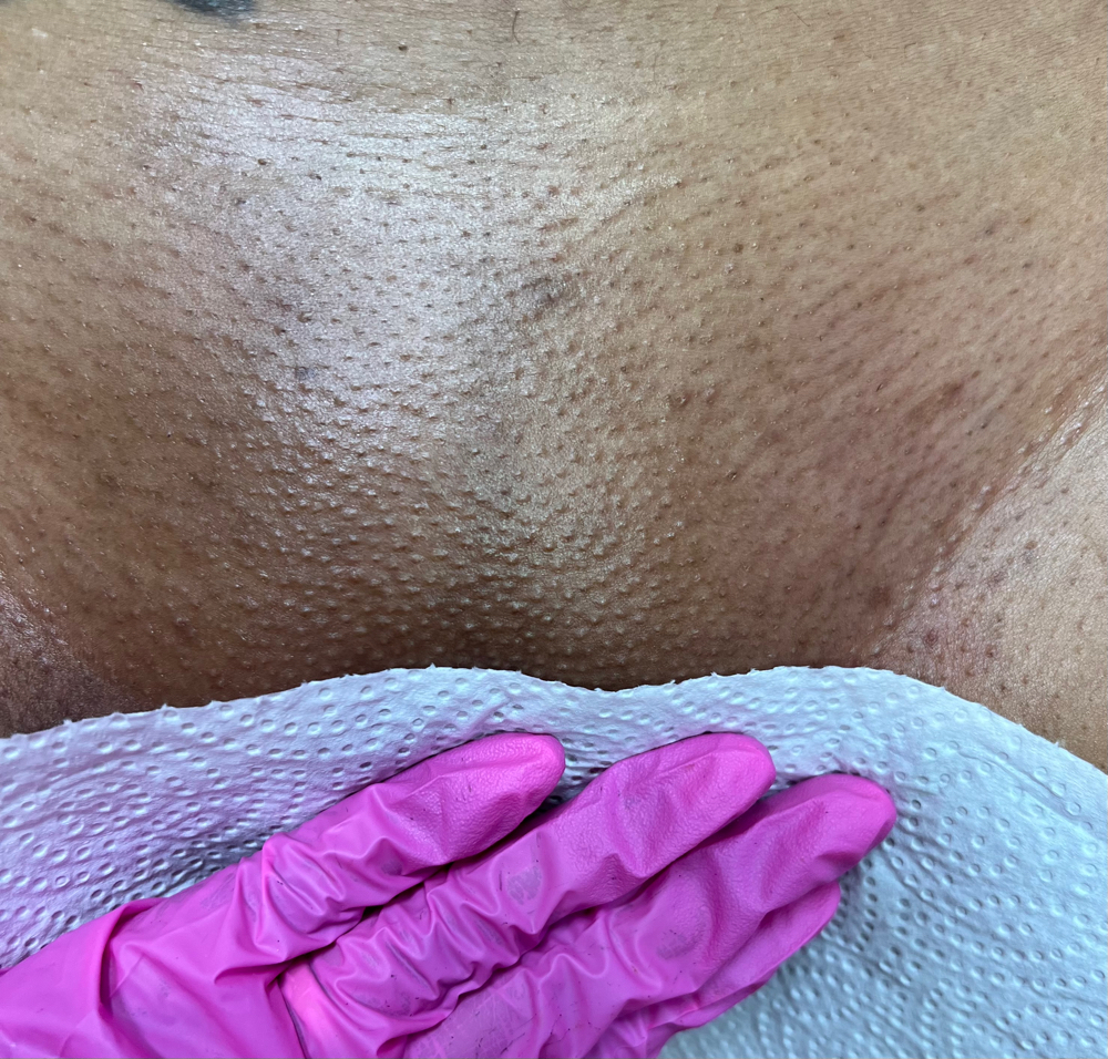 Waxing - Brazilian- female anatomy