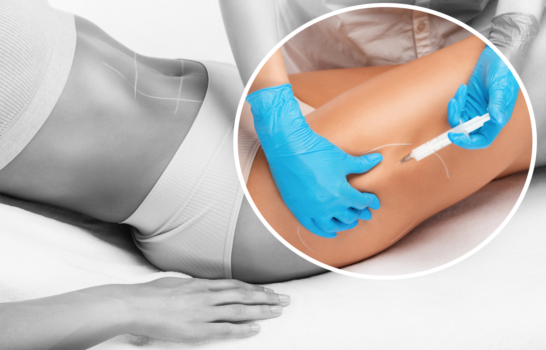 3 Treatments-2 Areas Max