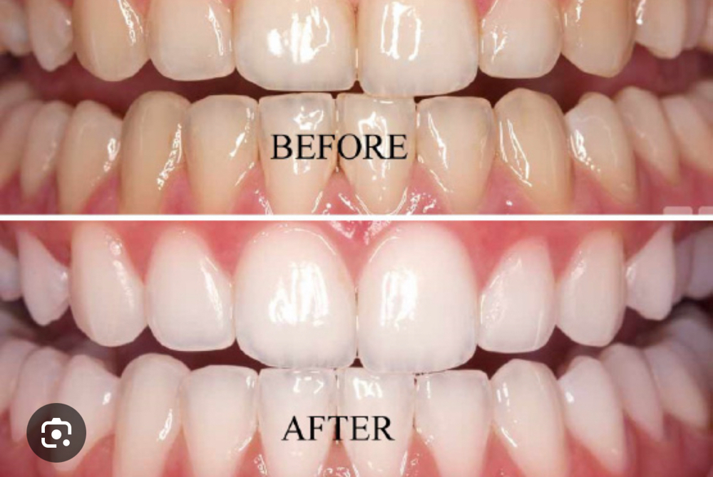 Teeth Whitening 90min at Heavenly aesthetic studio in Bronx, NY