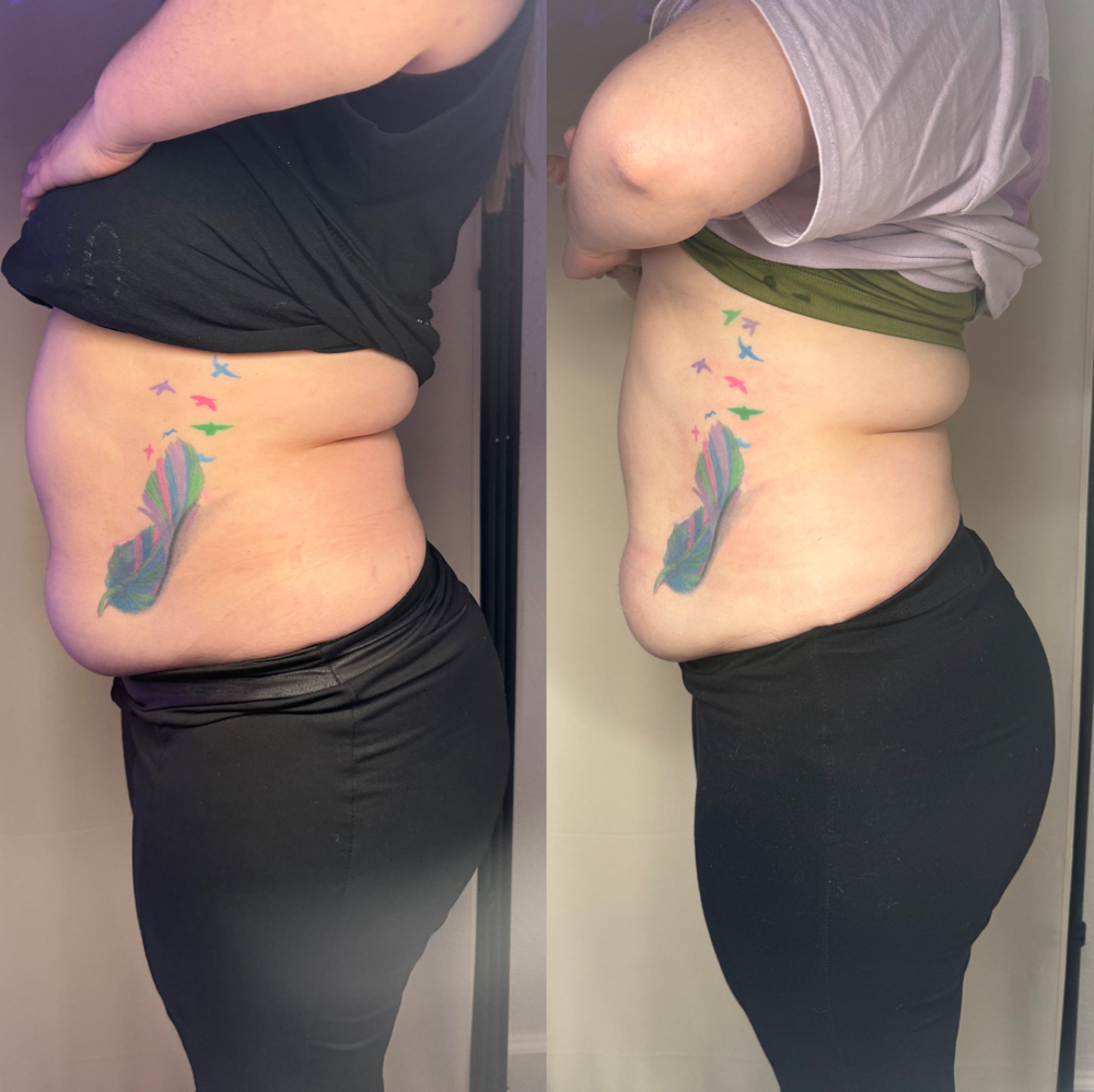 Body Contouring