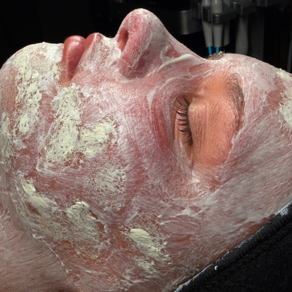 Acne Customized Facial at Hair Gone Wild in Belle Vernon, PA