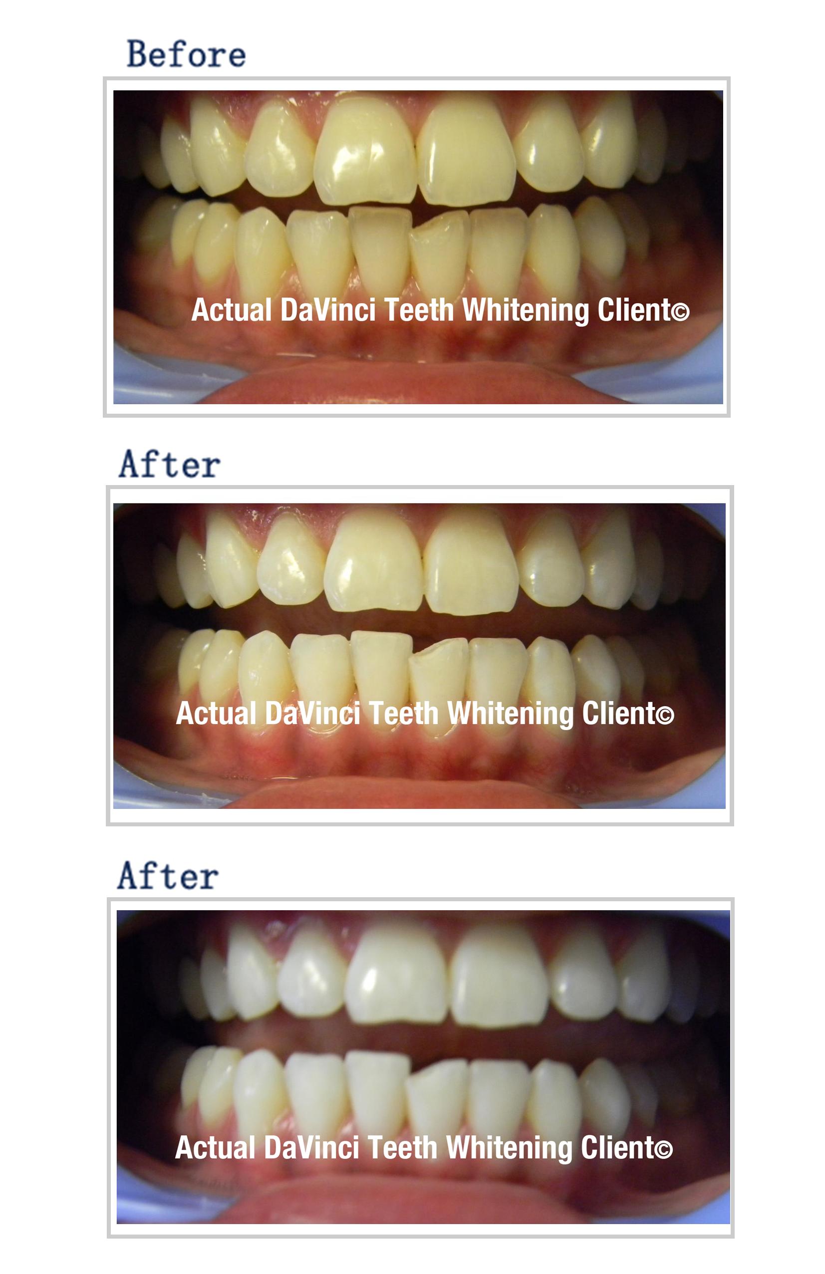 Teeth Whitening