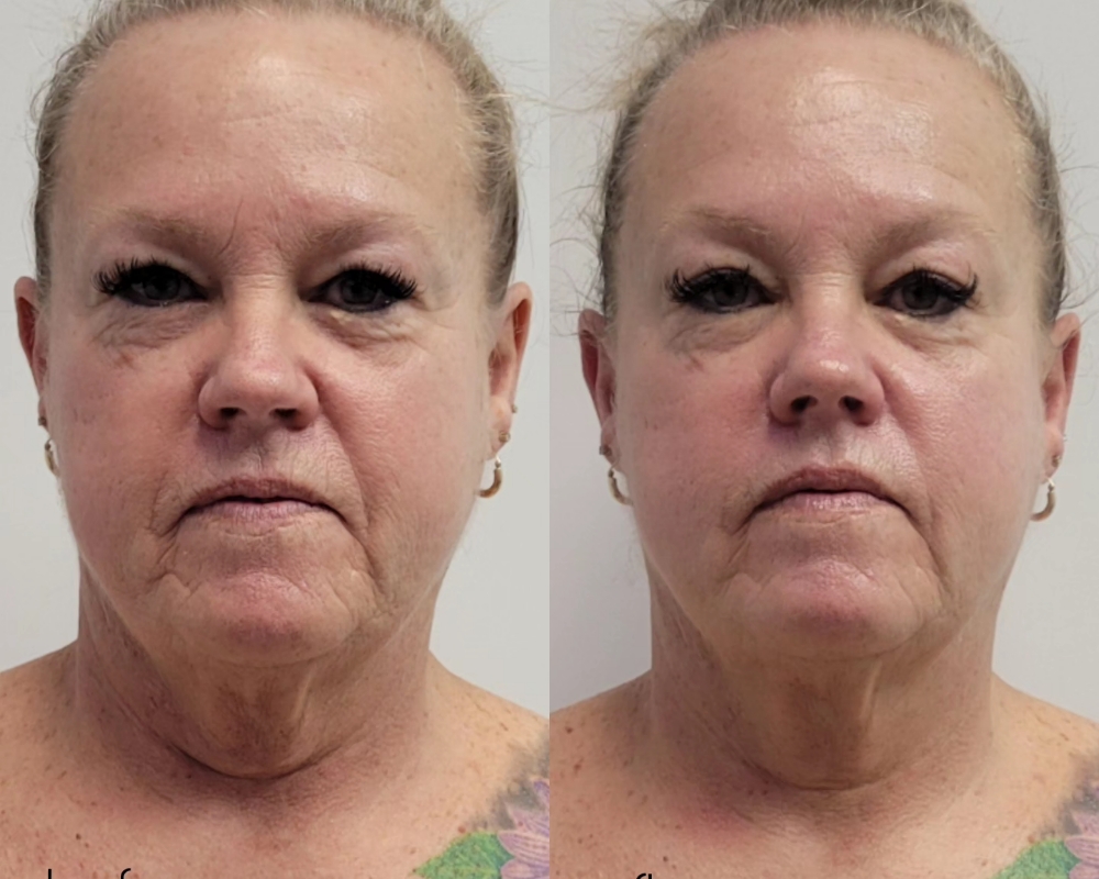 Face Lift  W/ Radiofrequency $111