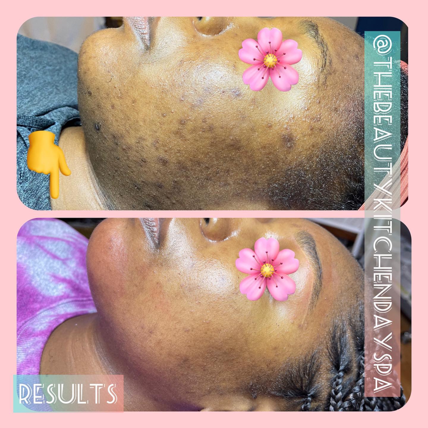 Hyperpigmentation Treatments