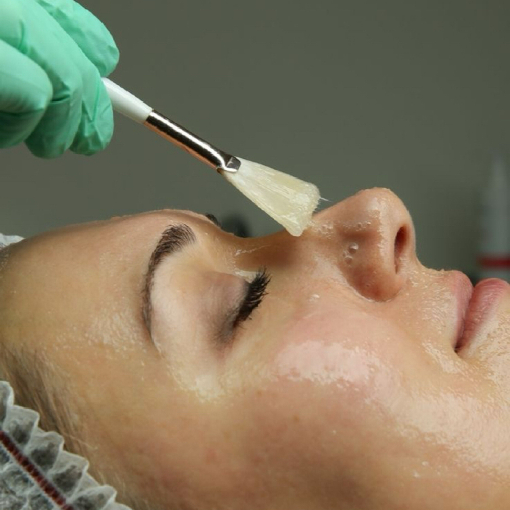 Glycolic Chemical Peel at Atelier Beauty Collective in Tucson, AZ
