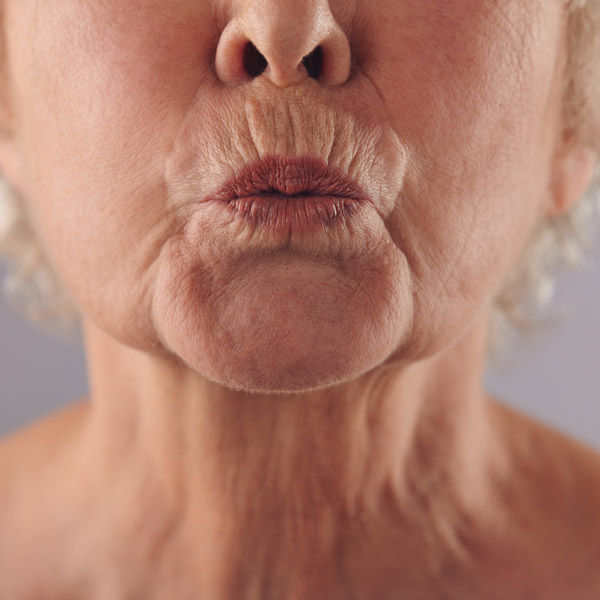Lip Lines
