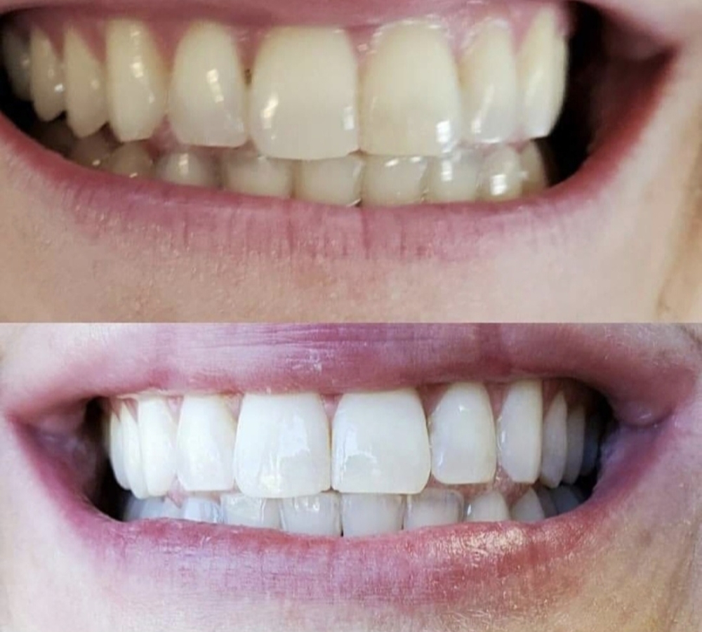 Teeth Whitening