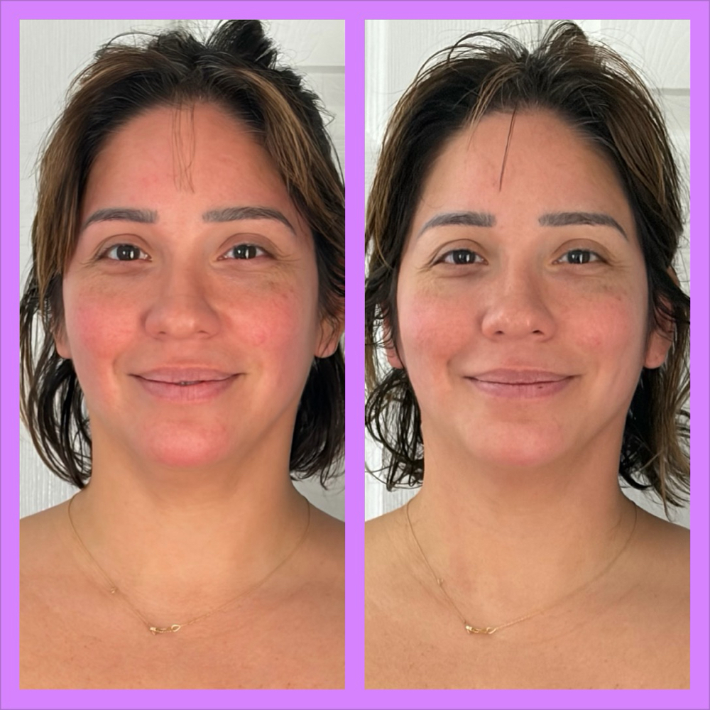Buccal Facial