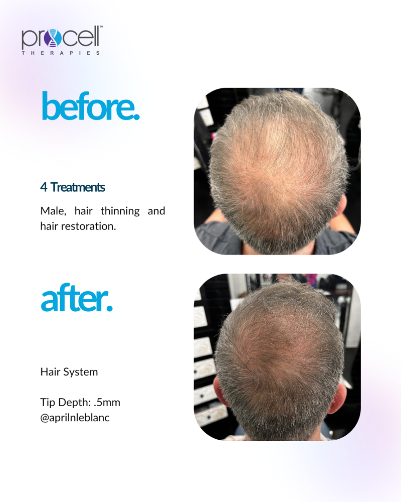 Hair Follicle Rejuventation
