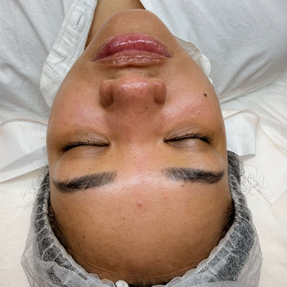 HydroDiamond Luxe Facial at Estediva Aesthetics in Long Island City, NY