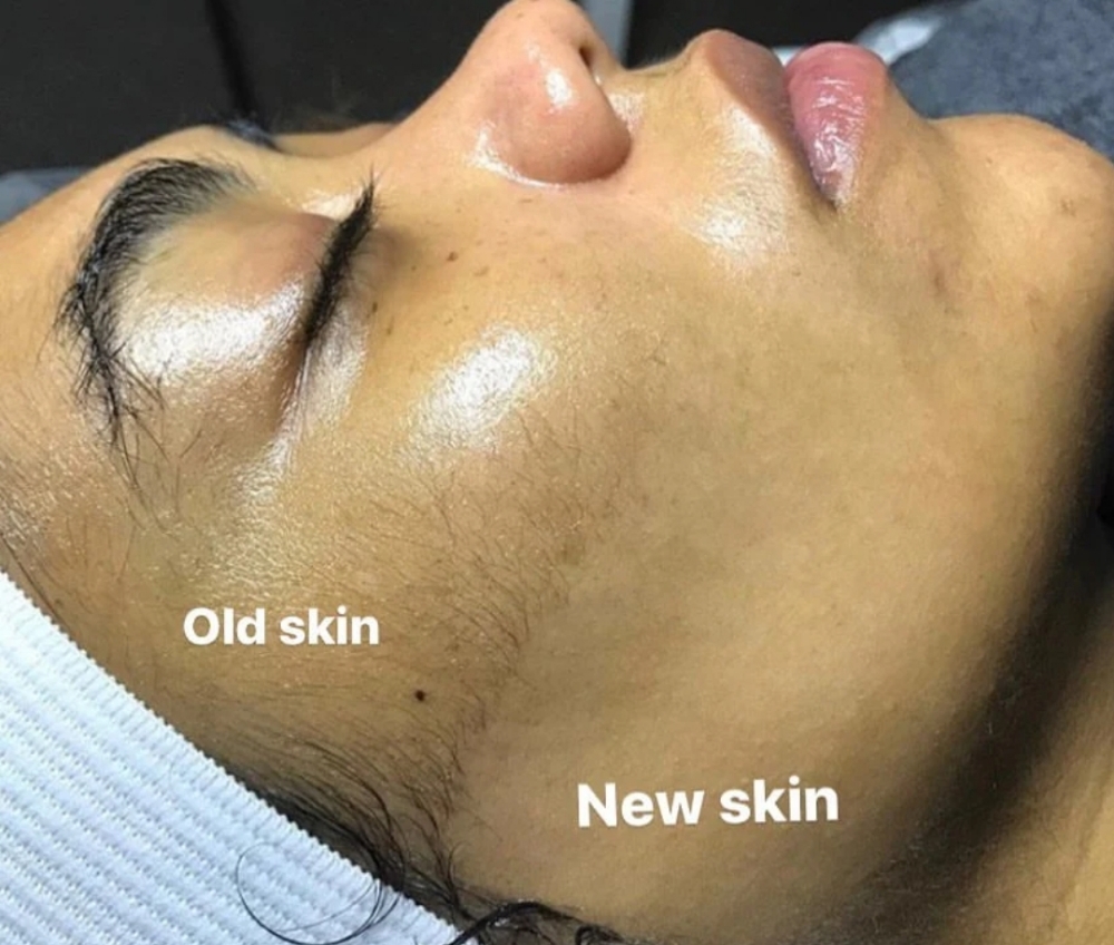 Dermaplaning Facial