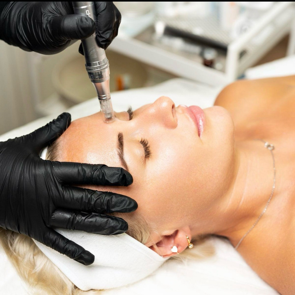 Microneedling at Blue orchid esthetics in Vineyard Have., MA