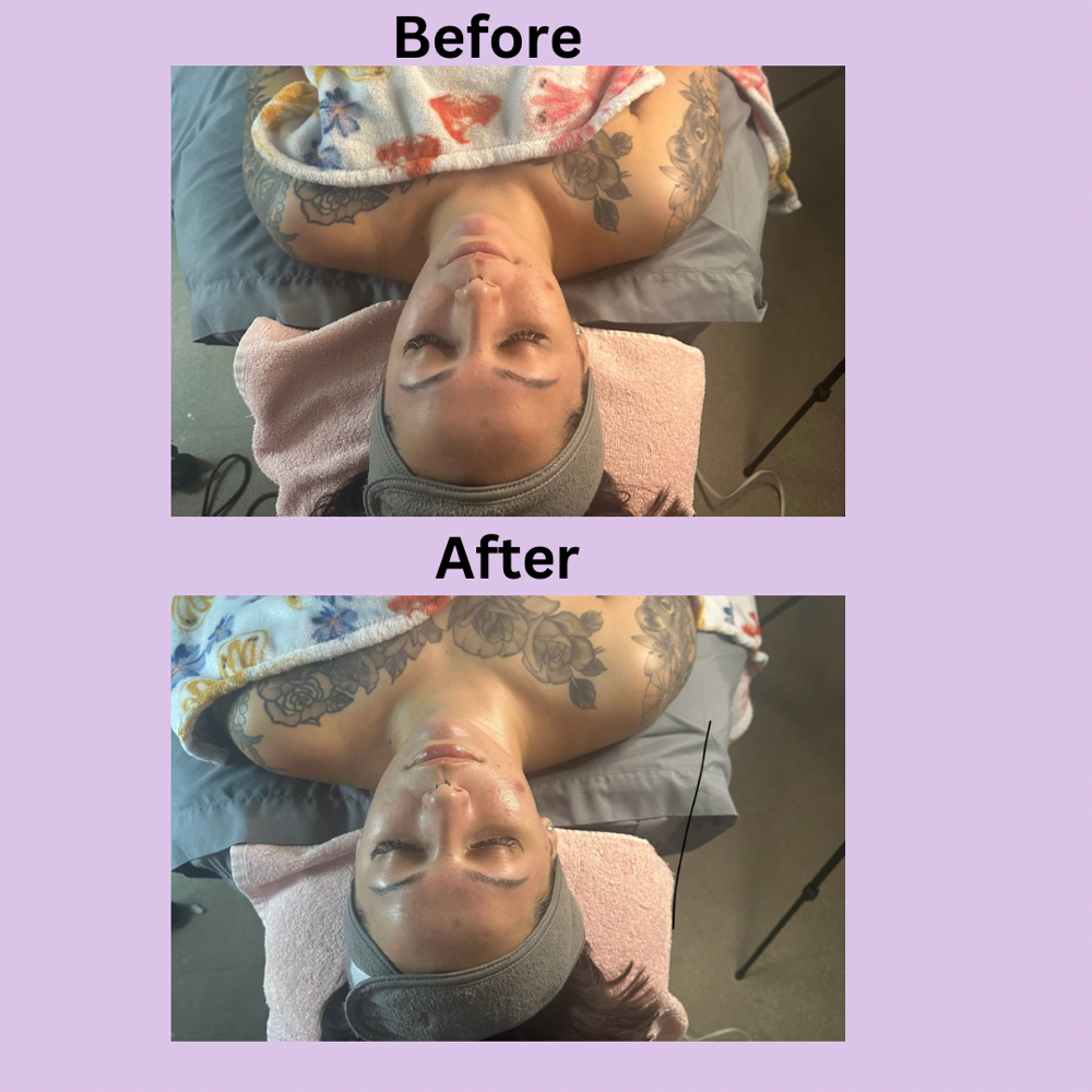 Deluxe Dermaplane