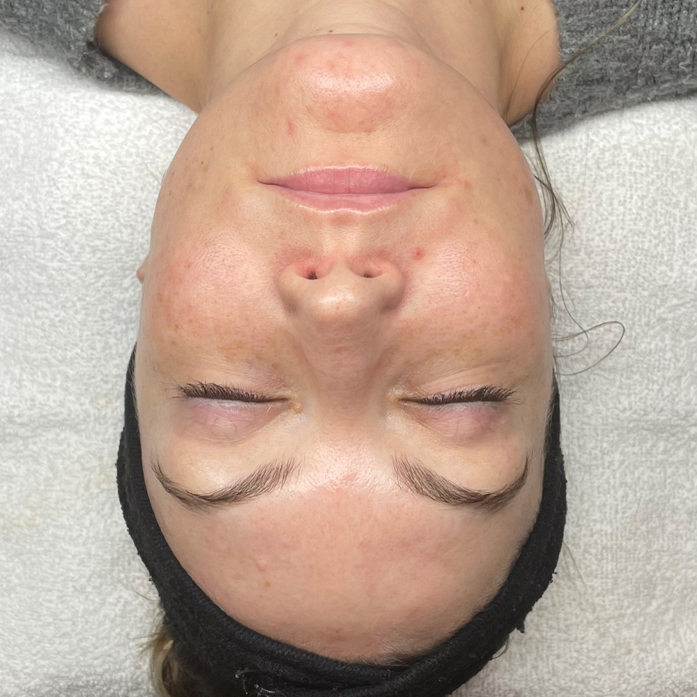 50% Lactic Acid Facial