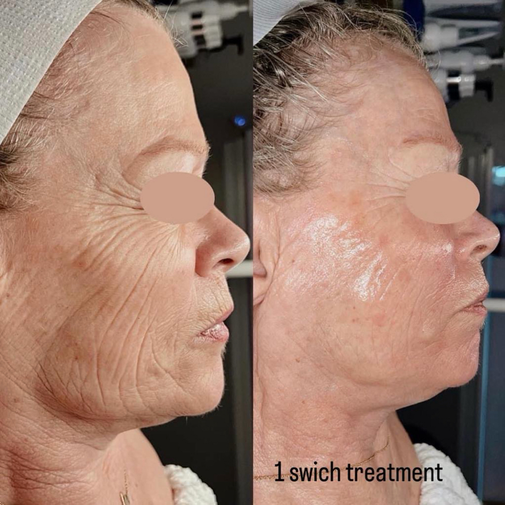 SWiTCH RENEWAL FACIAL at Marleen Skin Studio in Weatherford, OK