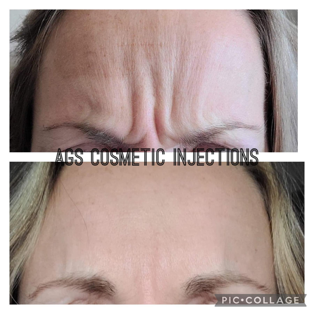 Botox / Xeomin