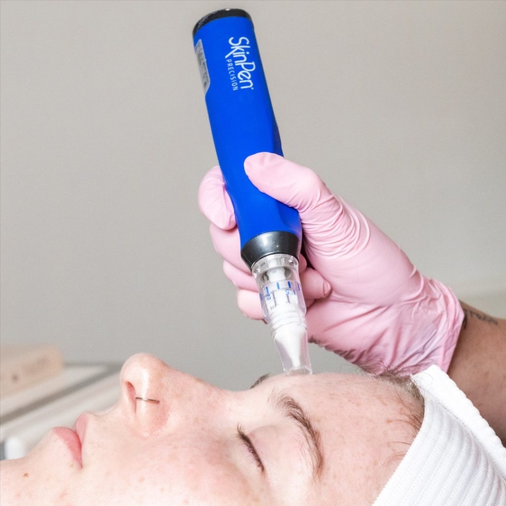 Microneedling at Natural Vybe in Newport Beach, CA