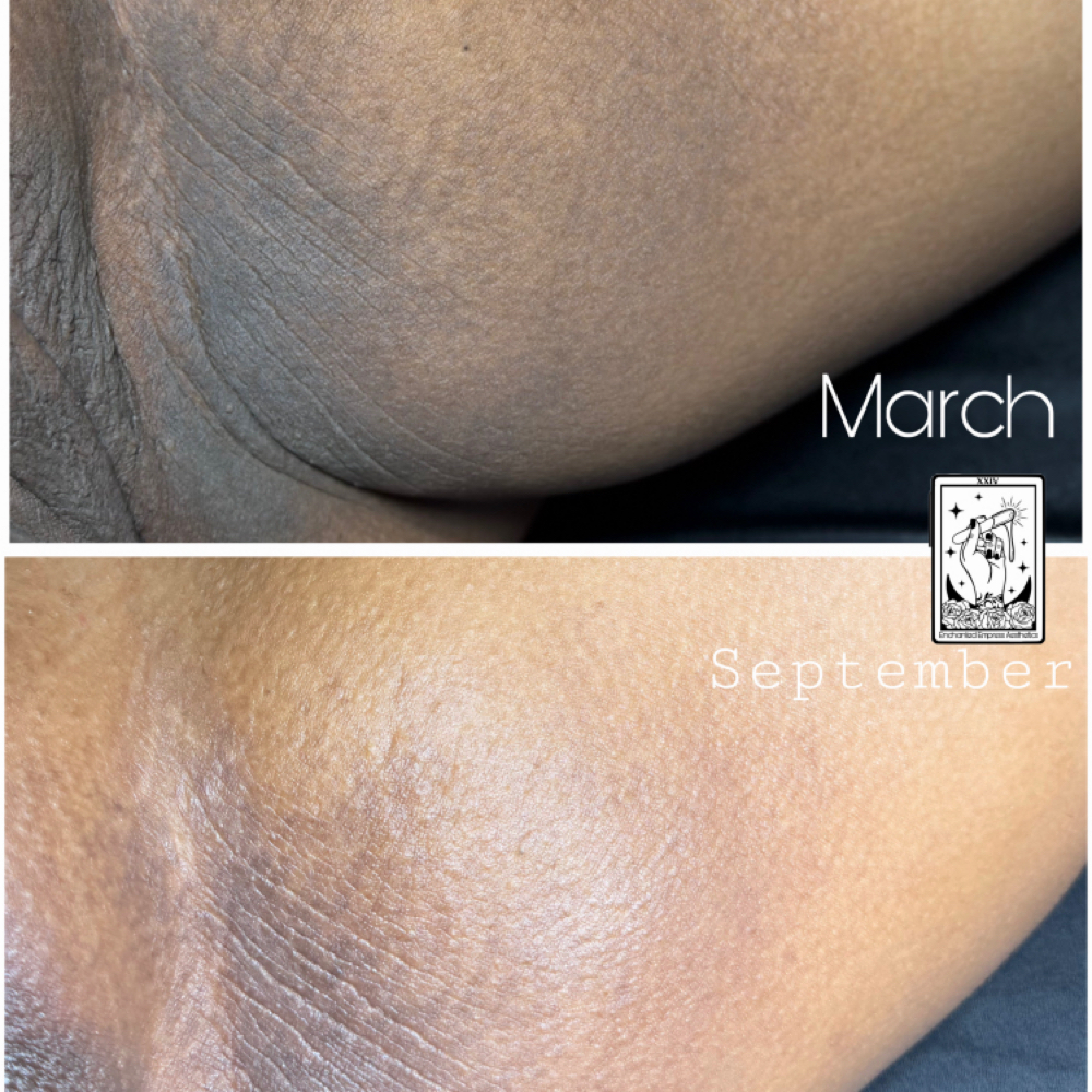 Skin Lightening / Bleaching at Enchanted Empress Aesthetics in Lynnwood, WA